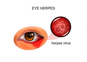 Blepharitis Symptoms and Causes