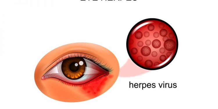 Blepharitis Symptoms And Causes News185 2106