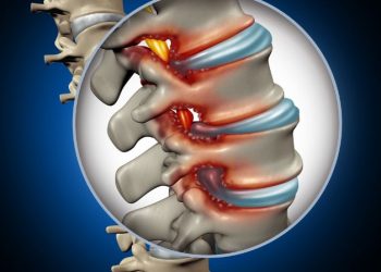 Stenosis Symptoms and Treatments