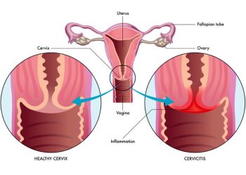 Cervicitis Symptoms