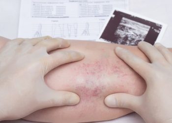 Varicose Veins Symptoms and Treatments