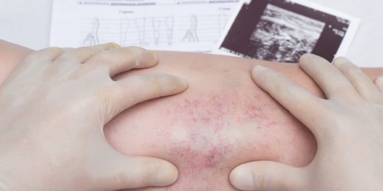 Varicose Veins Symptoms and Treatments