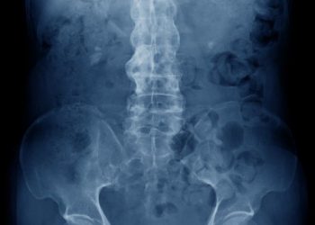 Ankylosis Spondylitis
