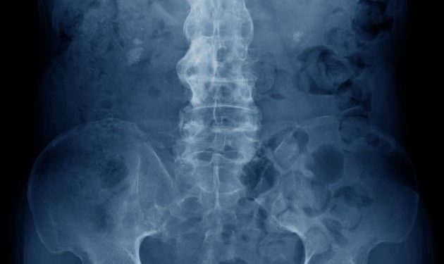 Ankylosis Spondylitis