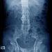 Ankylosis Spondylitis