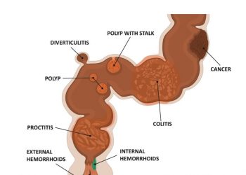What Are Proctitis Symptoms?