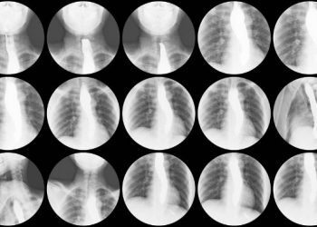 Esophagogastric Varices Symptoms and Causes