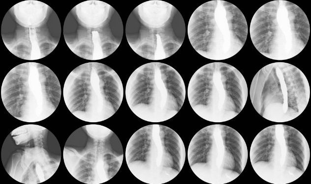 Esophagogastric Varices Symptoms and Causes