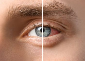 How to Treat Uveitis Symptoms