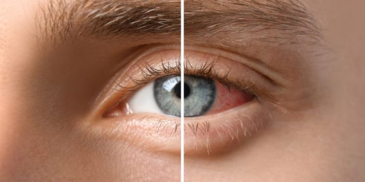 How to Treat Uveitis Symptoms