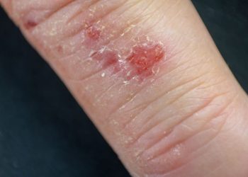 Seborrheic Dermatitis