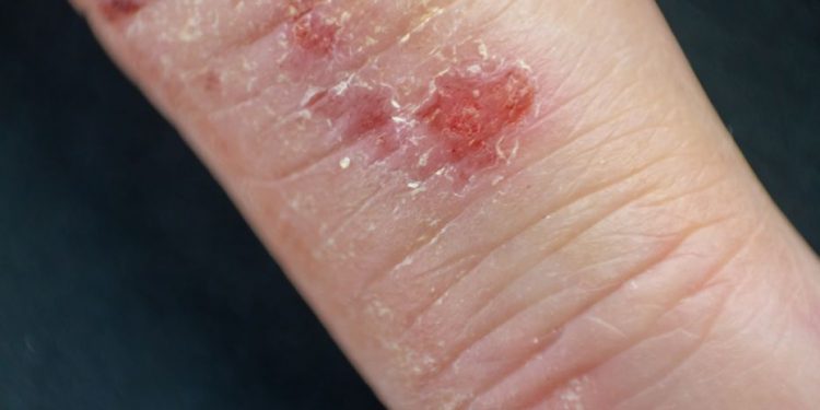 Seborrheic Dermatitis