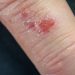 Seborrheic Dermatitis