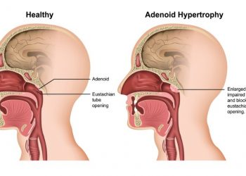Adenoid Hypertrophy