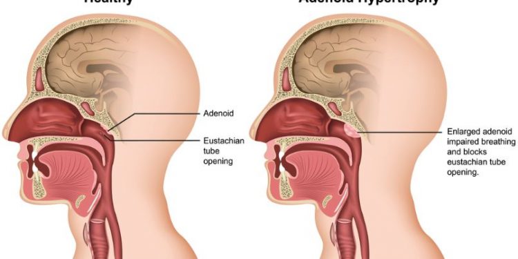 Adenoid Hypertrophy