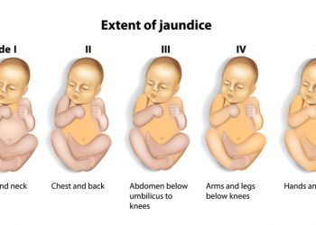 Neonatal Hepatitis Symptoms