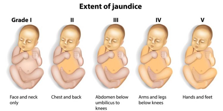 Neonatal Hepatitis Symptoms
