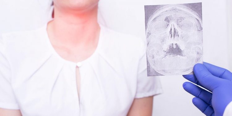 What Are Epiglottitis Symptoms?