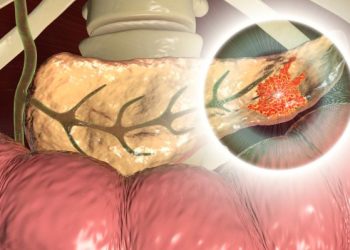 Pancreatitis Symptoms