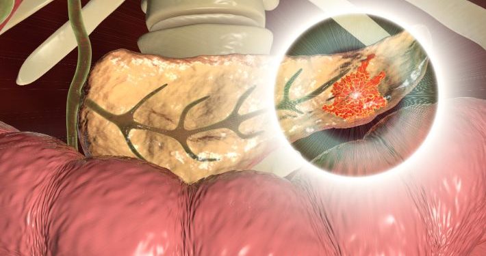 Pancreatitis Symptoms