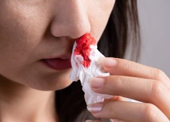 What Are Epistaxis Symptoms?