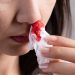 What Are Epistaxis Symptoms?