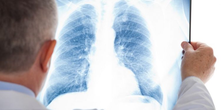 Pneumonia Symptoms
