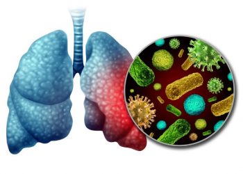 Pneumocystis Carinii Pneumonia Symptoms