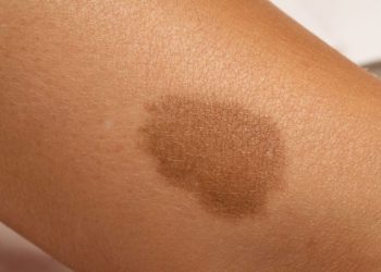 Hemangioma Symptoms in Children