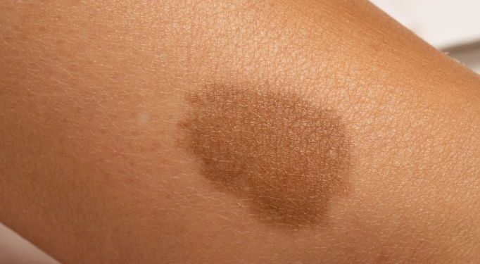 Hemangioma Symptoms in Children