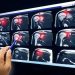Tendinitis Symptoms
