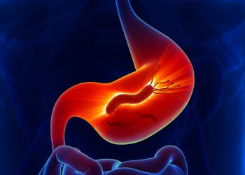 Helicobacter Pylori Symptoms and Treatment