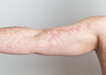 What Are the Symptoms of Hyperthermia?