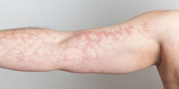 What Are the Symptoms of Hyperthermia?