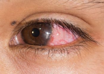 Bacterial Keratitis Cornea