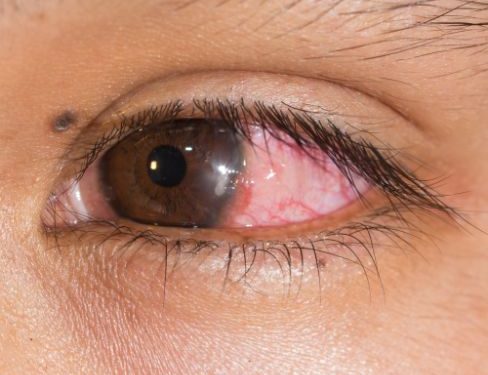 Bacterial Keratitis Cornea