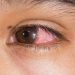 Bacterial Keratitis Cornea