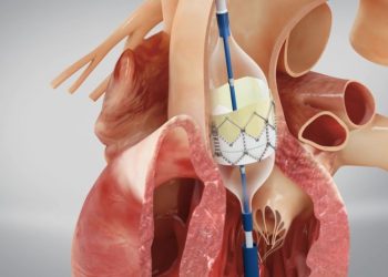 Aortic Valve Stenosis