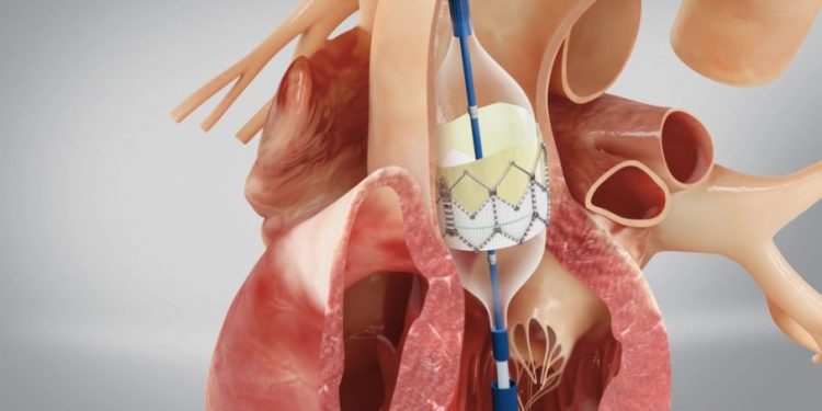 Aortic Valve Stenosis