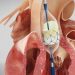 Aortic Valve Stenosis