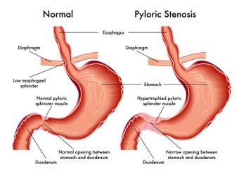 Pyloric Stenosis
