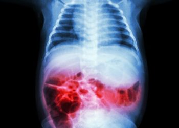 Necrotizing Enterocolitis in Babies