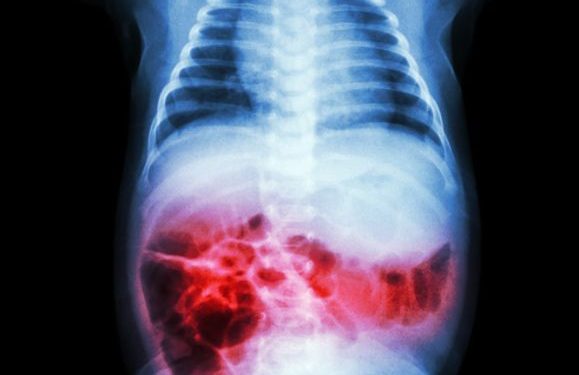 Necrotizing Enterocolitis in Babies