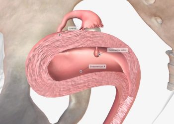 Endometritis Symptoms