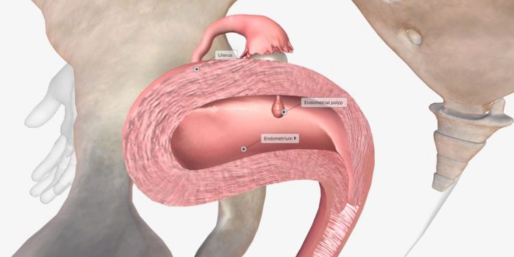 Endometritis Symptoms