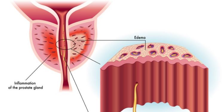 How to Deal With Prostatitis Symptoms