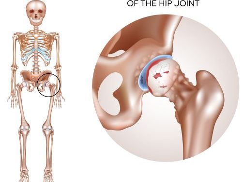 Osteoarthritis Symptoms