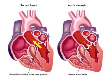 Endocarditis Symptoms