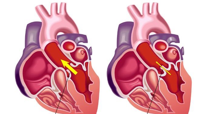 Endocarditis Symptoms