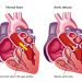 Endocarditis Symptoms